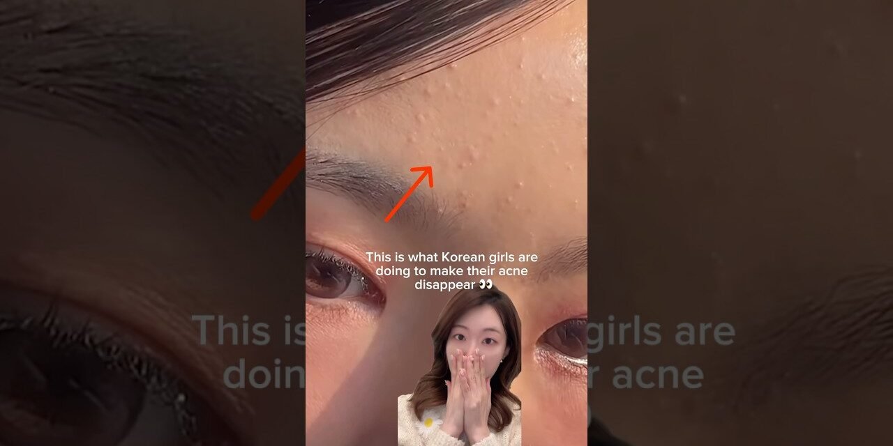 How Korean girls remove acne/tiny pimples/whiteheads #shorts