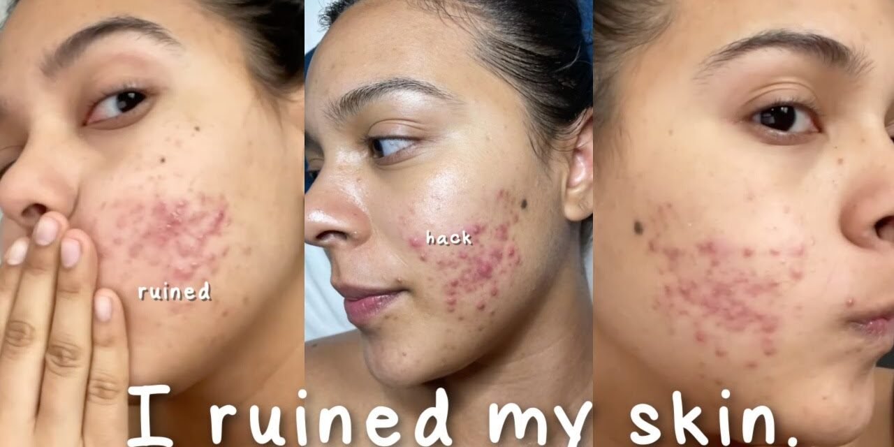 I Ruined My Skin with this Beauty Hack… #shorts #skincare