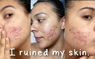 I Ruined My Skin with this Beauty Hack… #shorts #skincare