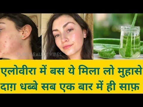 Remove pimples and scars permanently/how to remove pimples  /glowing and clear skin with aloevera