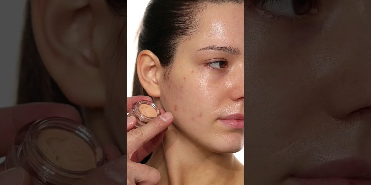 How to cover Acne