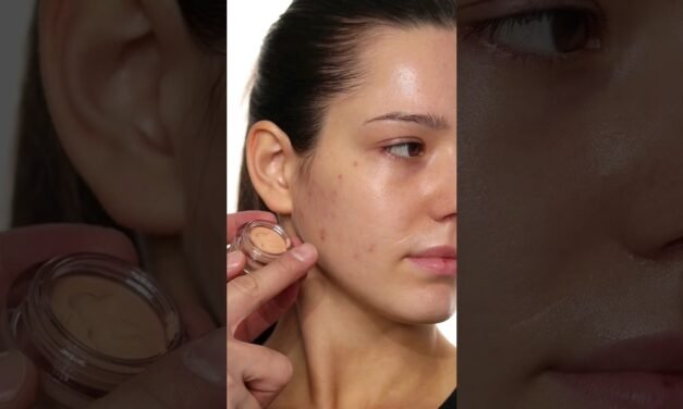 How to cover Acne