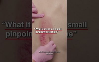 What Is The Meaning Of Gua Sha?