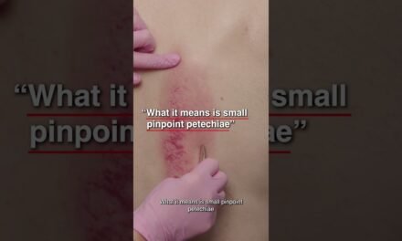 What Is The Meaning Of Gua Sha?