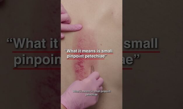 What Is The Meaning Of Gua Sha?
