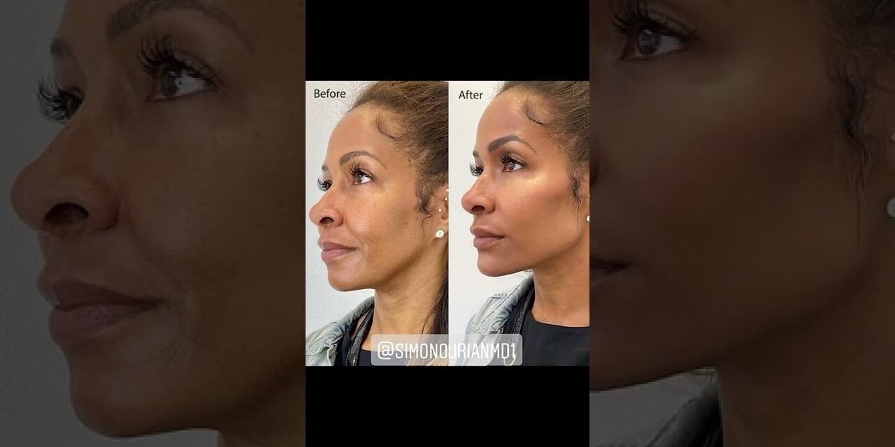 Instant, Non-Surgical Facial Contouring