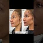 Instant, Non-Surgical Facial Contouring