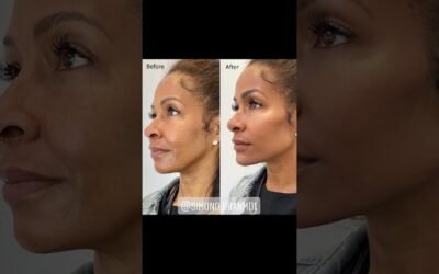 Instant, Non-Surgical Facial Contouring