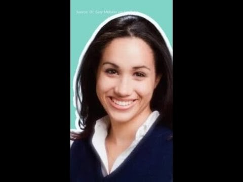 Meghan Markle's Nose Job, Botox and Veneers revealed by expert